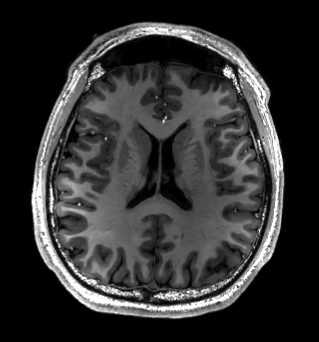 A cross-section MRI scan of a healthy human brain