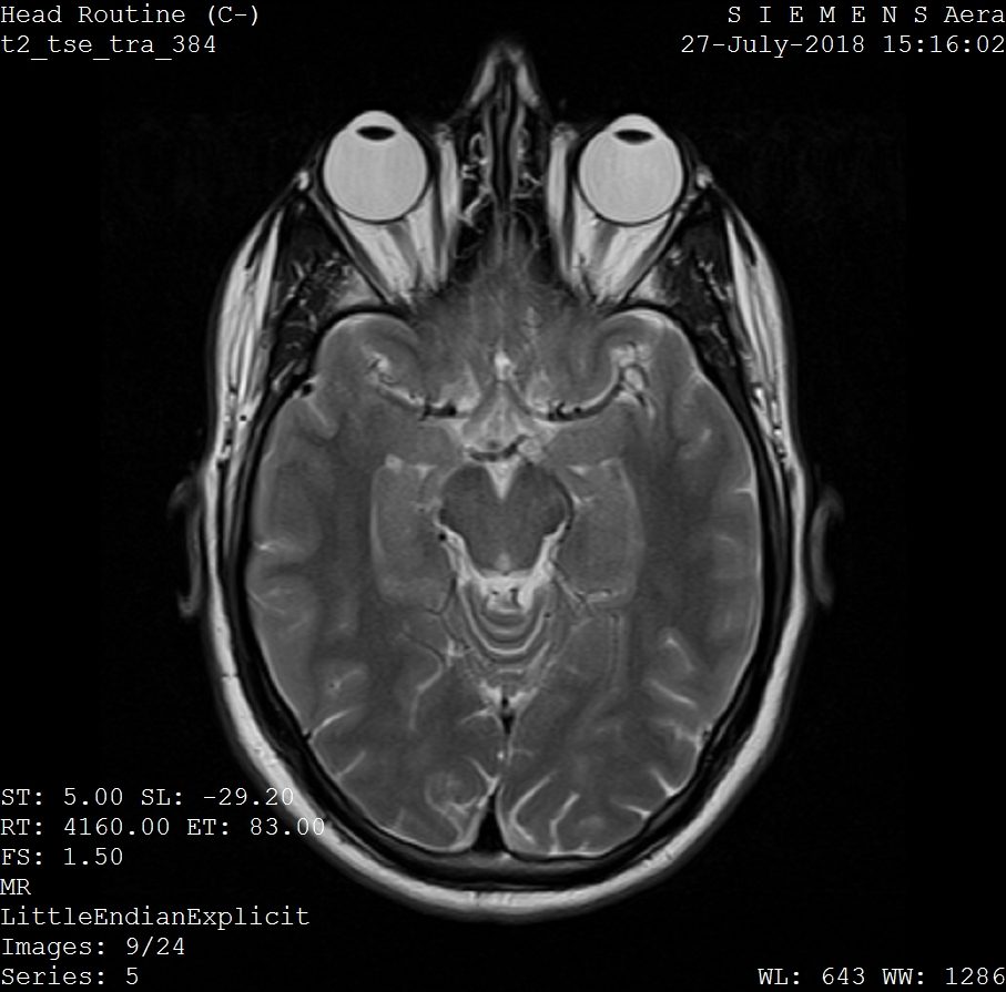 One frame from an MRI scan of a human head
