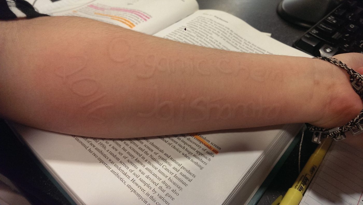Dermatographism, raised welts from scratching, on a 19-year-old's forearm