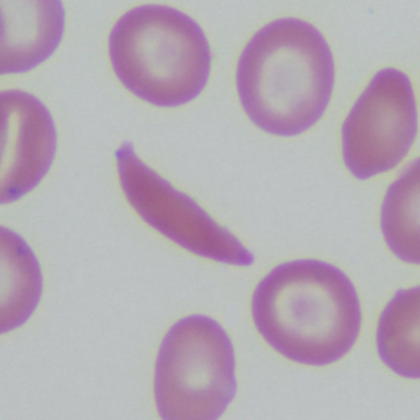 A microscope image of normal and sickle-shaped red blood cells from a patient with sickle cell disease
