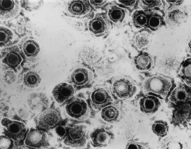 Electron micrograph of herpes simplex virus particles