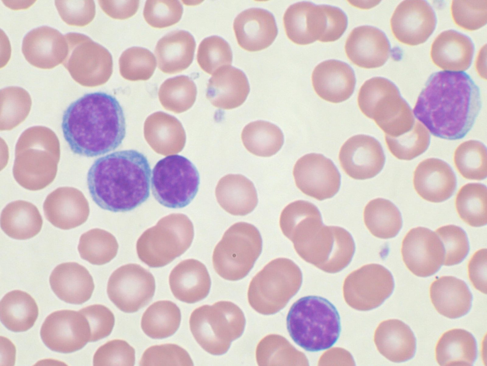 Blood smear showing chronic lymphocytic leukemia cells