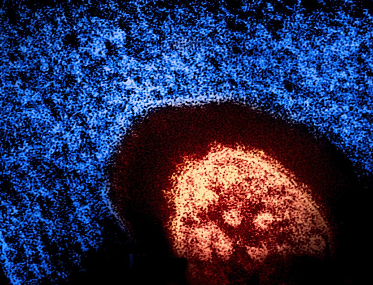 A colorized microscope image of a measles virus particle