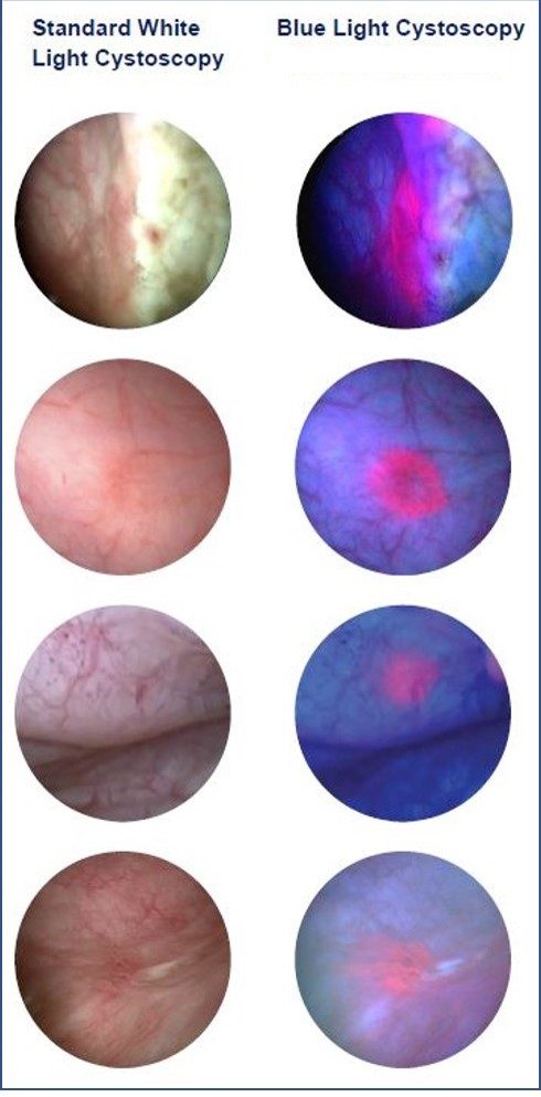 Cystoscopy images of the inside of a bladder