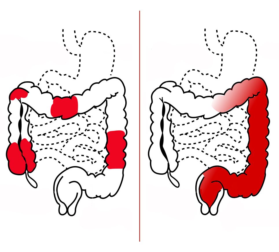 Diagram comparing two outlines of the intestines, with patchy red areas on the left and continuous red in the colon on the right