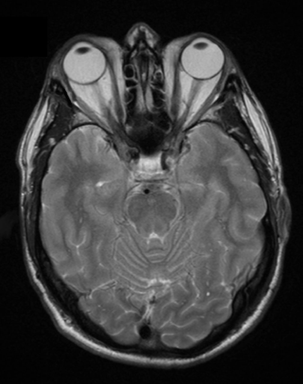 MRI scan of the eye sockets showing swollen muscles behind the eyes