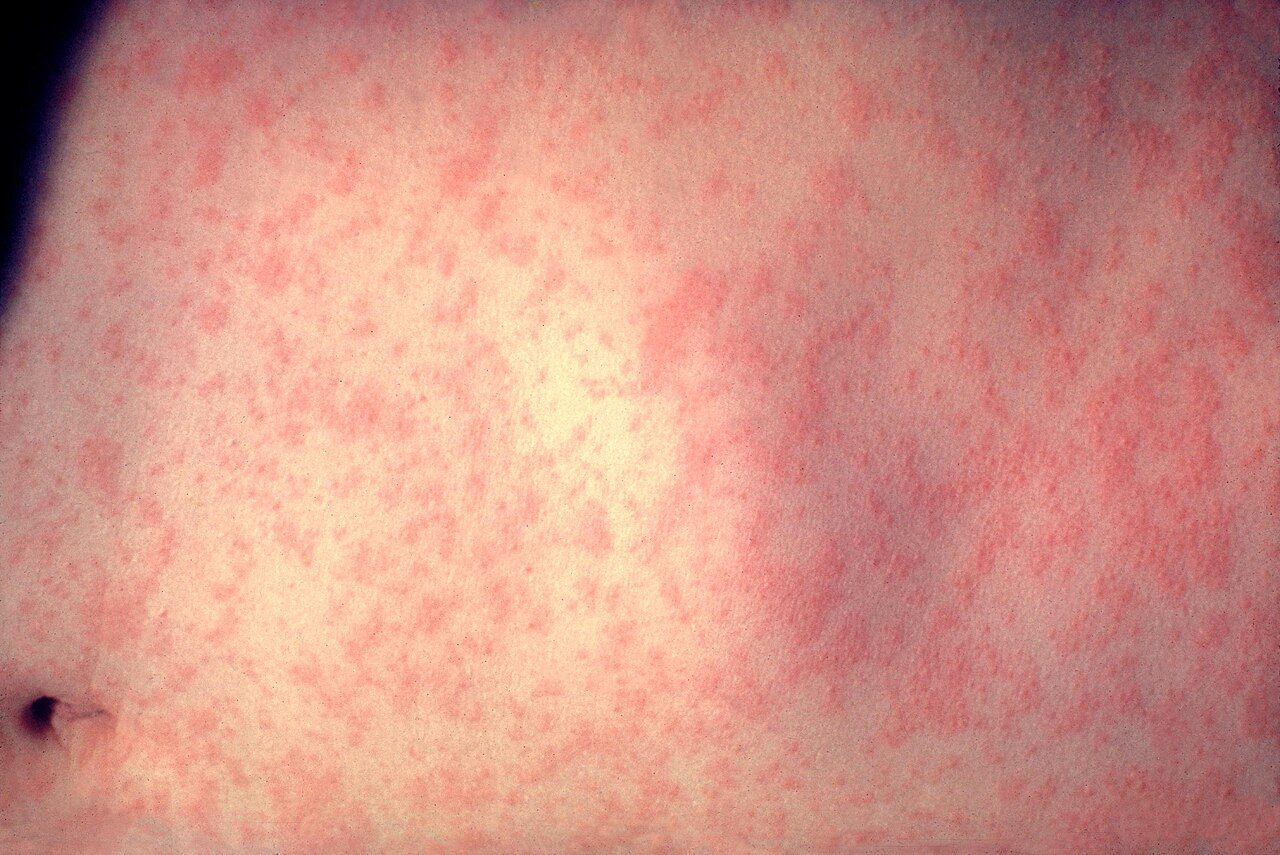 Close-up of skin covered in a blotchy red measles rash
