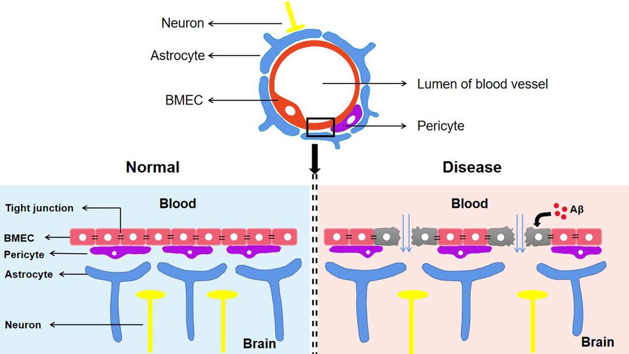 A diagram of how the blood-brain barrier can break down in Alzheimer's disease