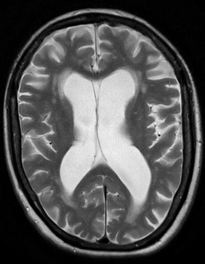 Brain atrophy from vascular dementia