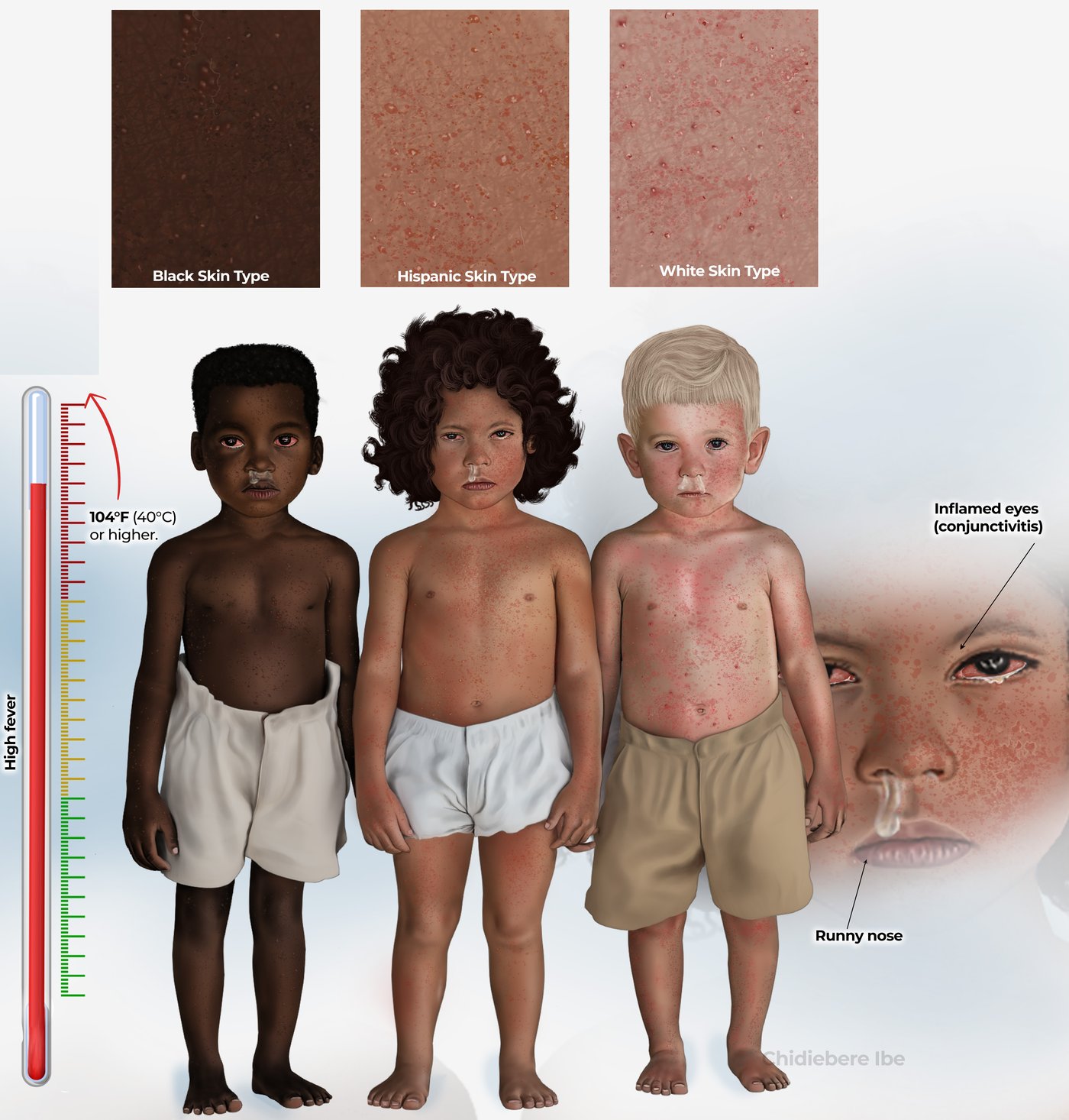 Illustration of how measles looks on different skin tones